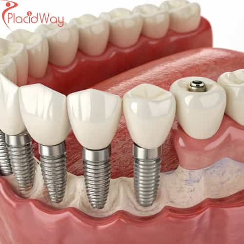 All-on-6 Dental Implants in Turkey for Munich Patients with Missing Teeth